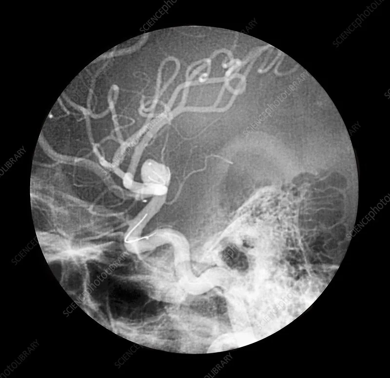 რა არის ანევრიზმა?